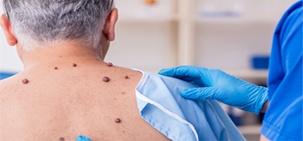 Tipos de Melanoma