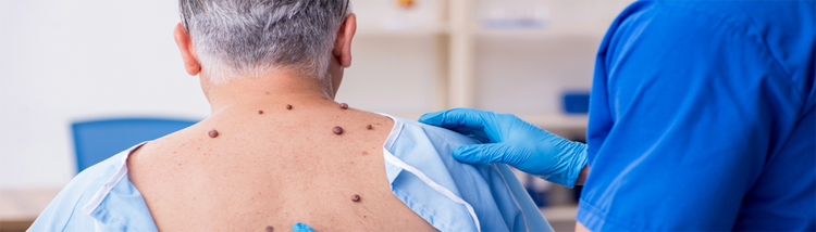 Tipos de Melanoma